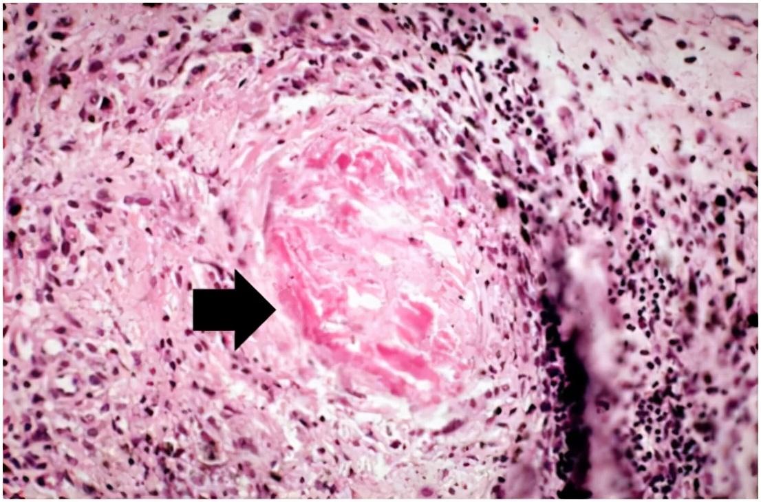 智能科技引领类风湿治疗新时代,最新研究突破揭示新希望