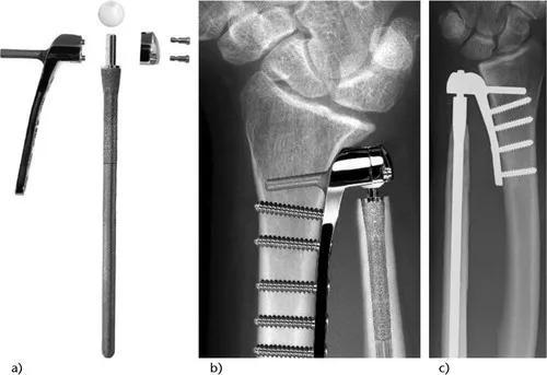 马德隆畸形最新治疗方法揭秘,小巷深处的神秘小店