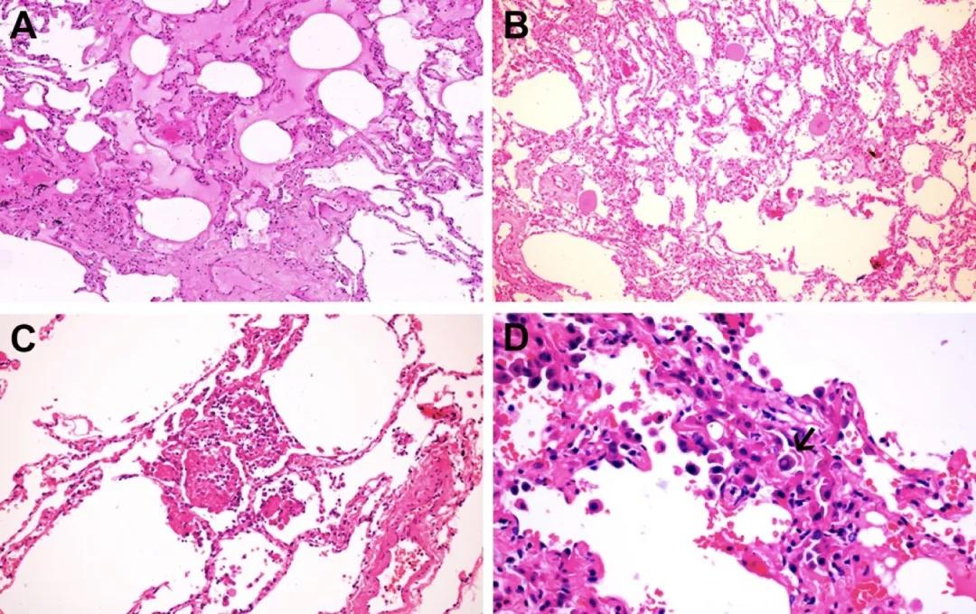 肺炎最新深度解析